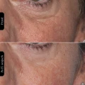 Silk’n Facial LED Mask 100