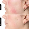 Silk’n Facial LED Mask 100